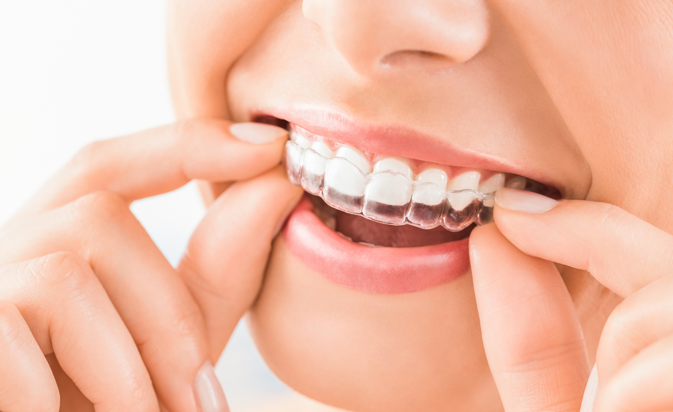 Are Invisible Braces Worth It? How They Work?